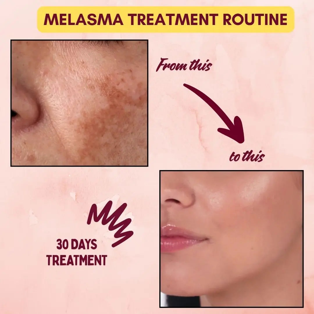Melasma Treatment Pack - 3 in 1 Velours